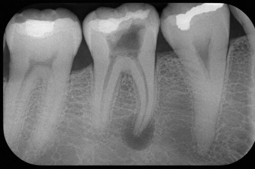 ¿Cuándo se necesita una endodoncia?